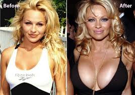 Pamela Anderson Plastic Surgery Pictures