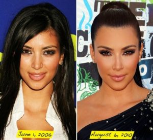 kim_kardashian_plastic_surgery_before_after_picture